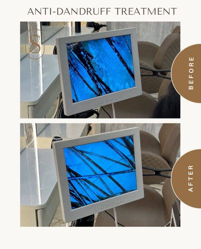 Anti-dandruff scalp treatment at Skinnish salon Mangalore, Uppala, Ullal for healthy, flake-free scalp