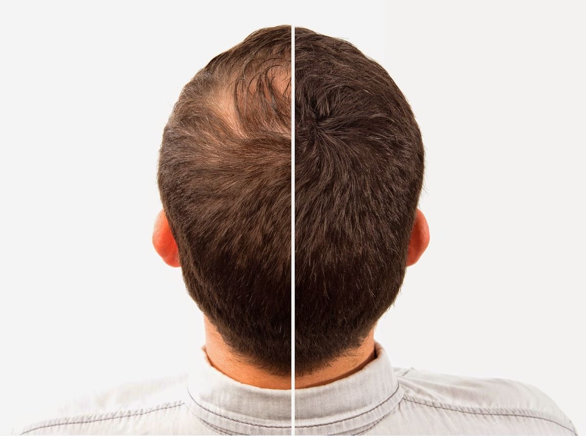 Hair fall treatment at Skinnish salon Mangalore, Uppala, Ullal to reduce hair loss and promote growth