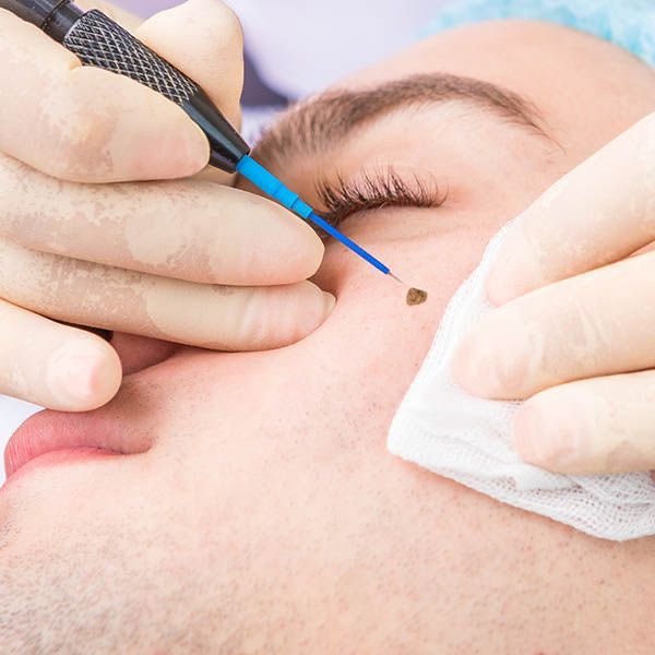 Safe mole and skin tag removal at Skinnish salon Mangalore, Uppala, Ulla