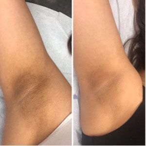 Underarm pigmentation removal at Skinnish salon Mangalore, Uppala, Ullal for smooth, even skin tone